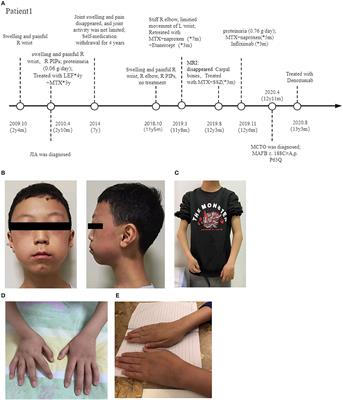 Multicentric Carpo-Tarsal Osteolysis Syndrome Mimicking Juvenile Idiopathic Arthritis: Two Case Reports and Review of the Literature